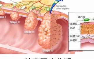 直肠癌晚期一般寿命多长 直肠癌手术费用大约多少钱