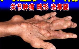 全面解析治疗风湿性关节炎的有效方法与策略