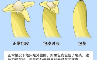 【揭秘包茎：什么是包茎及其相关知识解析】