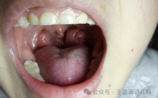 腺样体肥大是怎样形成的原因 腺样体肥大是拖出来的吗