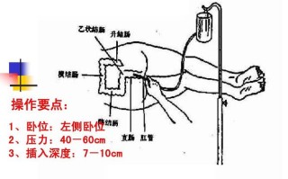 灌肠操作流程详解