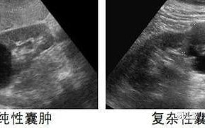 肾部囊肿需不需要治疗 肾囊肿最好不吃的东西