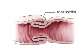 肠套叠的症状及表现 肠套叠的症状及治疗