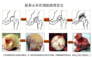 股骨头坏死早期症状详解