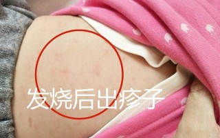 婴幼儿急疹：了解、预防与应对措施