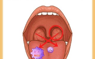 扁桃体化脓白点要警惕四种病 扁桃体化脓白点多久能退