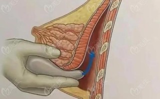 隆胸手术风险大吗 假体隆胸取出干瘪图片