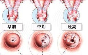 怎么判断自己是宫颈炎 怎么判断得了宫颈炎