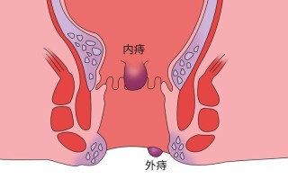 痔疮内痔是什么样的 内痔的最快消除方法