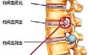 椎间盘膨出最佳治疗方法 椎间盘膨出可以治愈吗