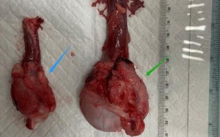 睾丸肿瘤的识别与应对：深入了解、早期治疗的重要性
