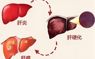 早期小肝癌复发率高吗 早期小肝癌可以治愈吗