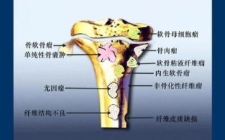 骨肿瘤是什么病 骨癌是怎么得的