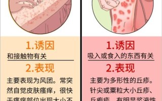 荨麻疹去药店买什么药 荨麻疹打一针就好了