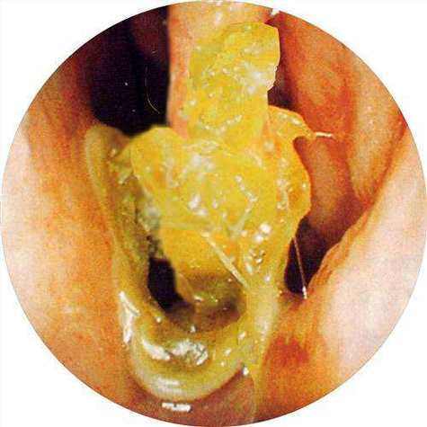鼻涕黄粘稠+喉咙疼痛 鼻涕由清转黄是好还是坏-第1张图片-其人生活百科