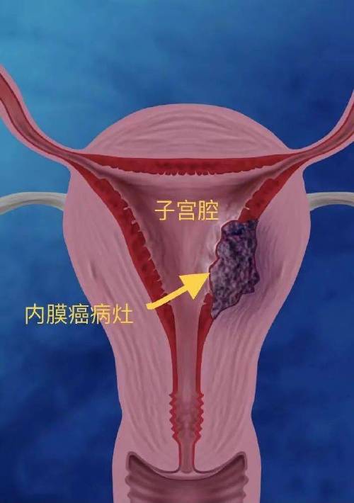 什么情况下会得子宫癌 得了子宫癌能活多久-第1张图片-其人生活百科