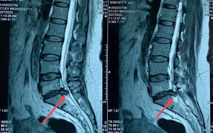 腰间盘突出站起来就痛 腰间盘突出的症状有哪些症状-第1张图片-其人生活百科