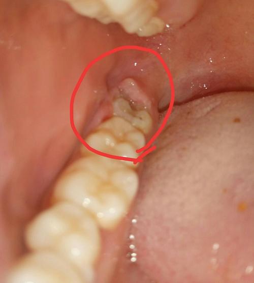 智齿疼痛：成因、缓解与应对之道-第1张图片-其人生活百科