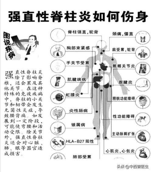 强直性脊柱炎并发症及其影响-第2张图片-其人生活百科