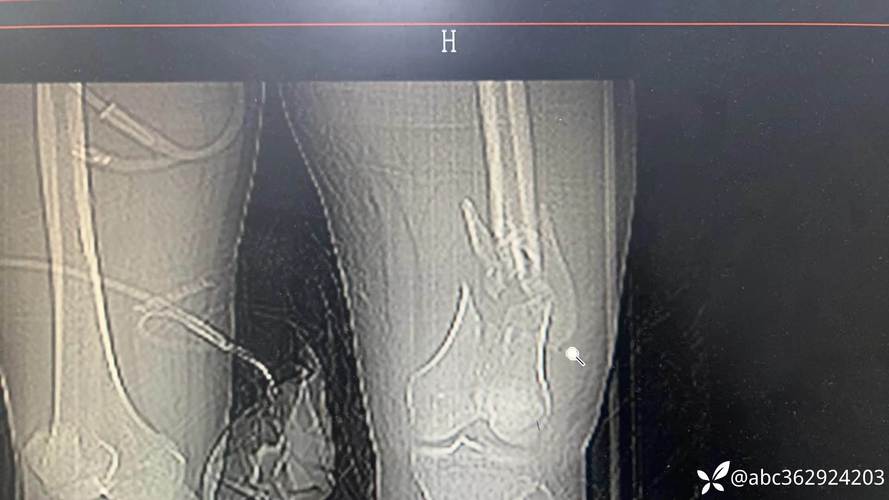 粉碎性骨折的成因、治疗与康复：深入了解与应对策略-第2张图片-其人生活百科