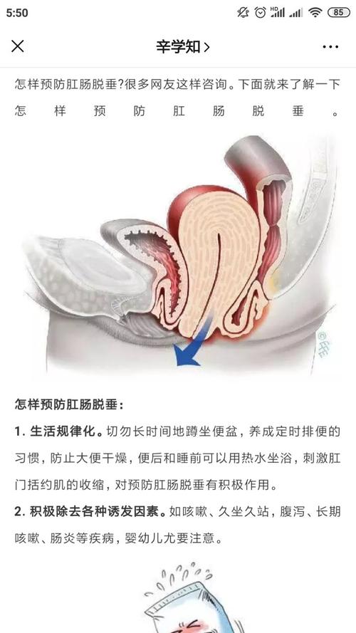 脱肛的症状及其影响：了解、预防与治疗-第2张图片-其人生活百科