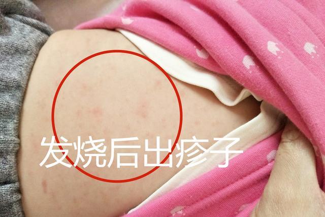 婴幼儿急疹：了解、预防与应对措施-第1张图片-其人生活百科