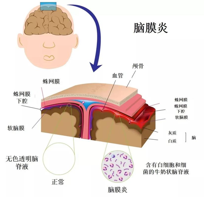 脑膜炎的症状表现及其识别重要性-第2张图片-其人生活百科