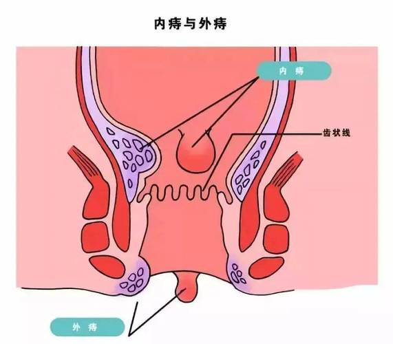 探究肛门疼痛背后的原因——一份详细解读-第1张图片-其人生活百科