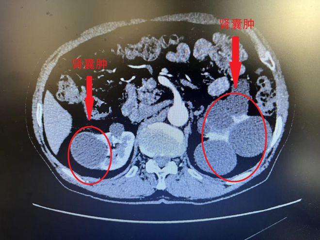 **肾囊肿的严重性及应对措施**-第2张图片-其人生活百科