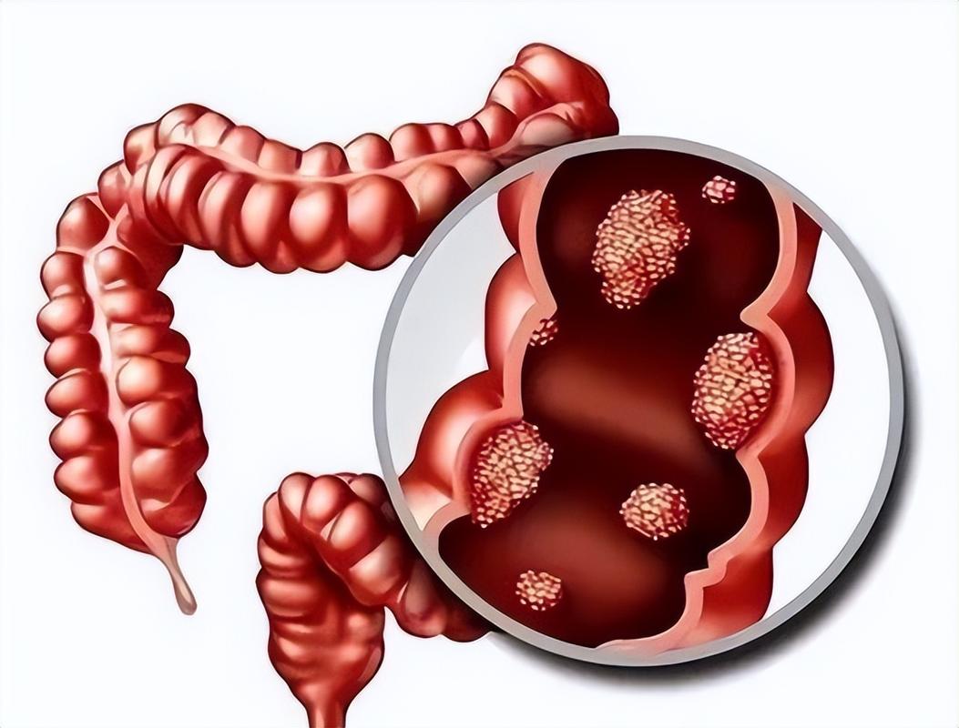 直肠肿瘤的症状及其影响：深入了解与应对-第1张图片-其人生活百科