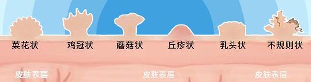 《深入了解尖锐湿疣：成因、诊断与治疗》-第1张图片-其人生活百科