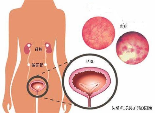 女性尿道感染：了解、预防与治疗-第2张图片-其人生活百科