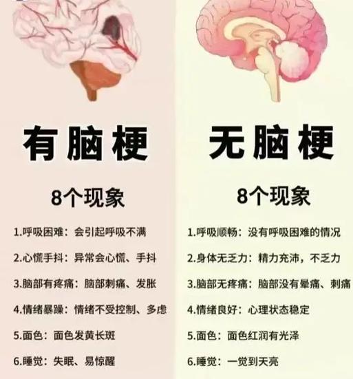 轻微脑梗塞：认识、预防与治疗-第1张图片-其人生活百科