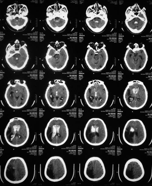 轻微脑梗塞：认识、预防与治疗-第2张图片-其人生活百科