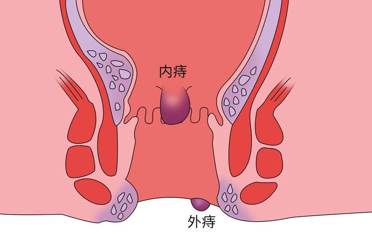 痔疮内痔是什么样的 内痔的最快消除方法-第1张图片-其人生活百科