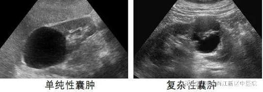 肾部囊肿需不需要治疗 肾囊肿最好不吃的东西-第1张图片-其人生活百科