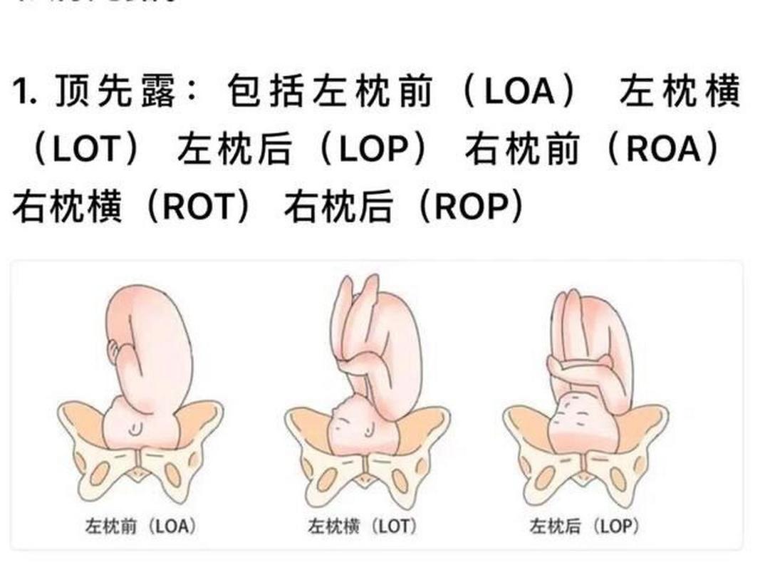 胎儿胎位 胎位的表示LOA,ROA...-第1张图片-其人生活百科