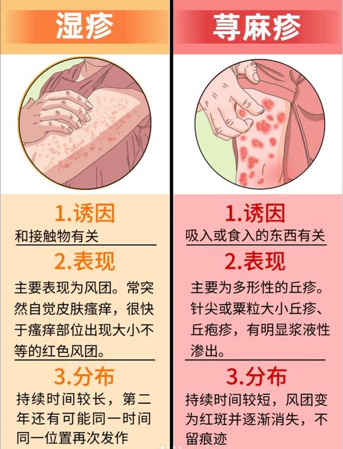 荨麻疹去药店买什么药 荨麻疹打一针就好了-第1张图片-其人生活百科