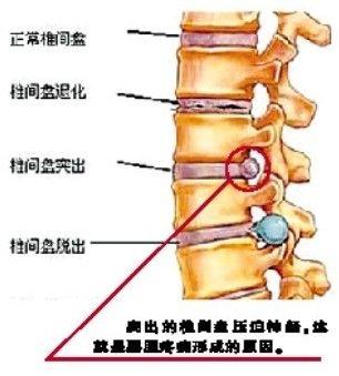 椎间盘膨出最佳治疗方法 椎间盘膨出可以治愈吗-第1张图片-其人生活百科