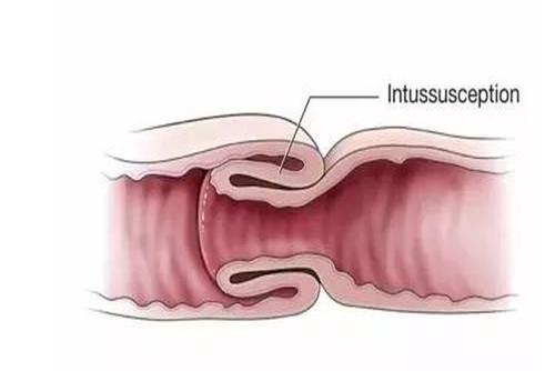 肠套叠的症状及表现 肠套叠的症状及治疗-第1张图片-其人生活百科