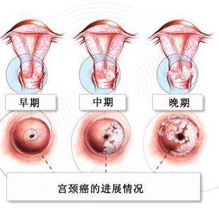 怎么判断自己是宫颈炎 怎么判断得了宫颈炎-第1张图片-其人生活百科