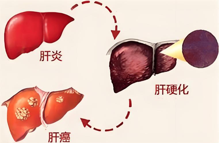 早期小肝癌复发率高吗 早期小肝癌可以治愈吗-第1张图片-其人生活百科