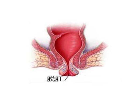 脱肛的自愈方法 脱肛特效药膏-第1张图片-其人生活百科