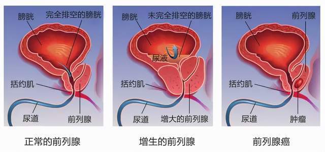 正常男性前列腺大小是多少 年轻人得了前列腺增大-第1张图片-其人生活百科