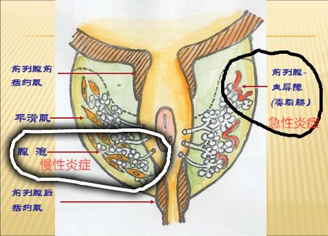 正常男性前列腺大小是多少 年轻人得了前列腺增大-第2张图片-其人生活百科