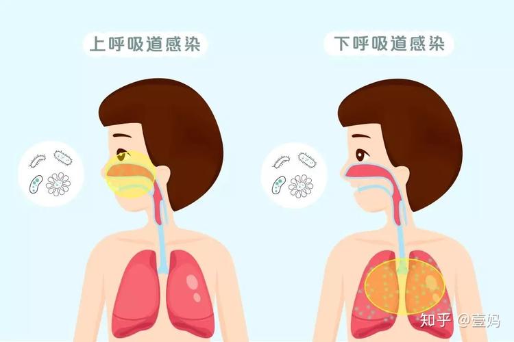 急性上呼道感染鉴别诊断疾病 孩子受凉呼吸道感染吃啥药好-第1张图片-其人生活百科